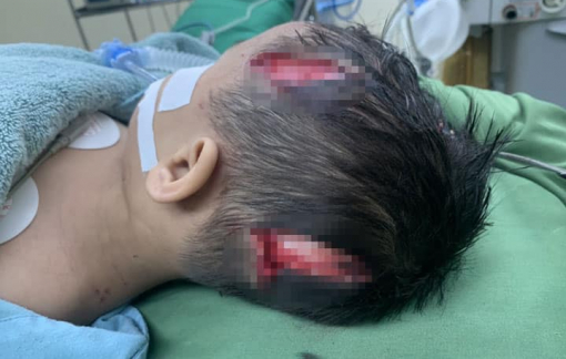 Bé trai bị chó nhà bà ngoại tấn công lộ xương sọ