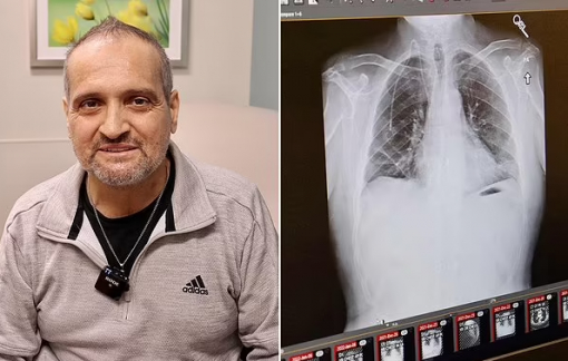 Ca ghép phổi "cực hiếm" cứu người đàn ông mắc ung thư giai đoạn cuối