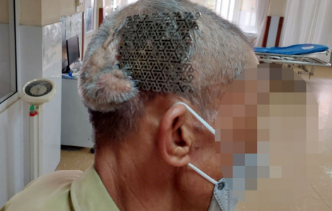Người đàn ông nhập viện với tấm Titanium hở trên sọ não
