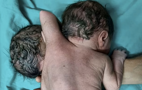 Các bác sĩ ở Ấn Độ sốc khi chào đón em bé 2 đầu 3 tay