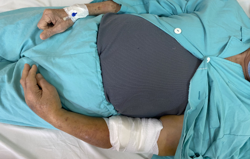 Cứu sống bệnh nhân 80 tuổi bị tắc động mạch cánh tay trái do huyết khối