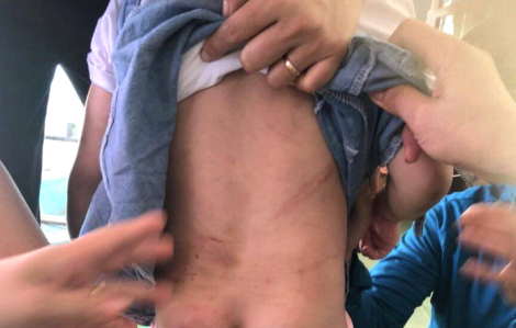 Hà Tĩnh: Bé gái 4 tuổi bị dì ruột đánh đến nhập viện