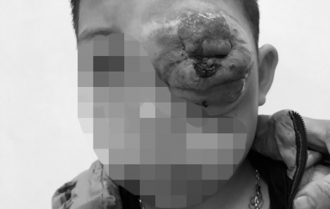 Bé trai bị lồi mắt, gương mặt biến dạng vì không có tiền chữa trị bệnh