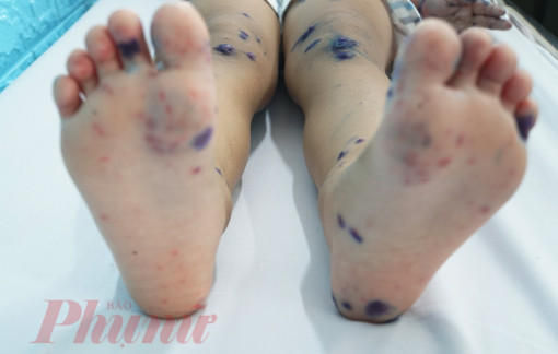 Làm sao biết trẻ bị COVID-19, sốt xuất huyết hay tay chân miệng?
