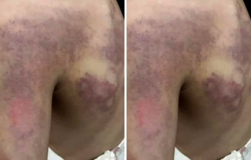 Đình chỉ cô giáo đánh nữ sinh lớp 3 bầm tím vai