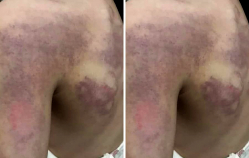 Mẹ hốt hoảng phát hiện con gái bầm tím vai sau khi đi học về