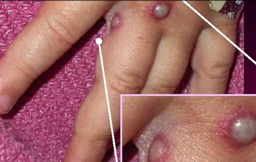 Bệnh đậu mùa khỉ có khả năng lây lan qua đường tình dục