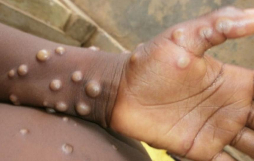 WHO: "Bệnh đậu mùa khỉ bùng phát bất thường nhưng có thể kiểm soát được"