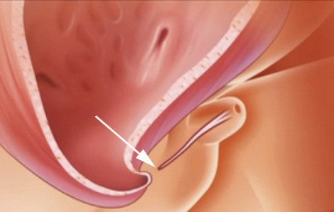 Bé trai bị dị tật lỗ tiểu thấp: Cần điều trị sớm