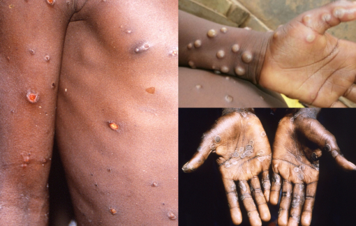 Bệnh đậu mùa khỉ bùng phát dữ dội nhưng khó dẫn đến đại dịch như COVID-19