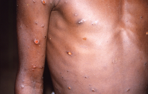 Đã có bệnh nhân đậu mùa khỉ tử vong trong năm 2022