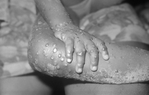 Anh yêu cầu cách ly bệnh nhân đậu mùa khỉ 21 ngày, không nên quan hệ tình dục