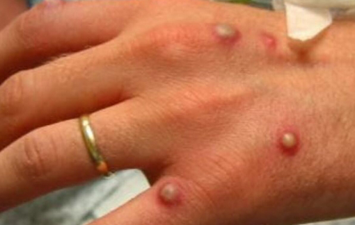 Đã có hơn 550 ca mắc đậu mùa khỉ ở 30 quốc gia