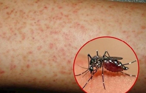 Vì sao dịch sốt xuất huyết tại TPHCM tăng mạnh?