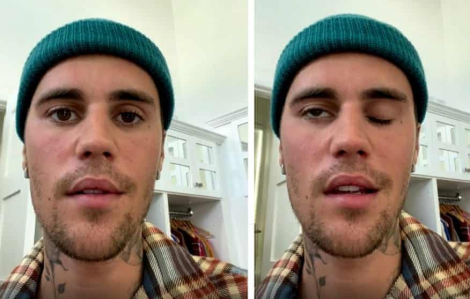 Justin Bieber bị liệt mặt vì mắc bệnh hiếm