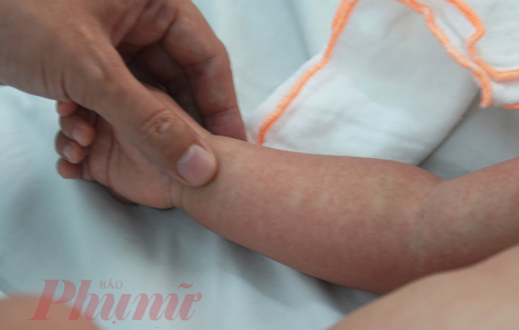 Trẻ bị sốt xuất huyết dễ trở nặng hơn khi từng nhiễm COVID-19