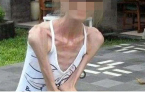 Ám ảnh ăn kiêng, người phụ nữ 30 tuổi gây sốc khi chỉ nặng 25kg