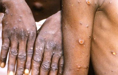 WHO xóa bỏ phân biệt quốc gia lưu hành bệnh đậu mùa khỉ