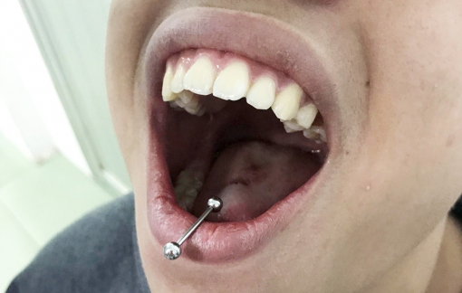 Cẩn trọng với trào lưu xỏ khuyên lưỡi ở thanh thiếu niên