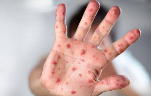 WHO kêu gọi hành động khẩn cấp khi bệnh đậu mùa khỉ tăng không thể kiểm soát, lây cho cả trẻ em