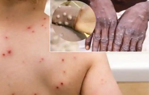 WHO lại triệu tập ủy ban khẩn cấp bệnh đậu mùa khỉ, Singapore phát hiện ca đầu tiên