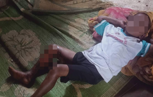 Công an thông tin sự thật vụ bé trai 8 tuổi bị đốt phỏng chân