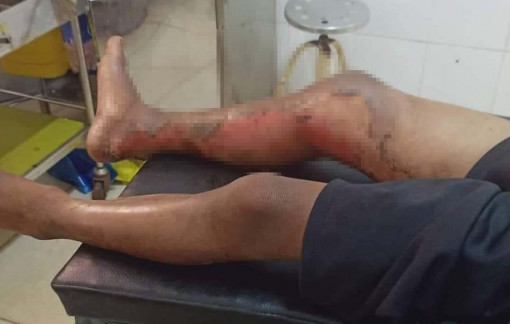 Nghi vấn bé trai 8 tuổi bị đốt bỏng chân vì không chịu trộm mủ cao su