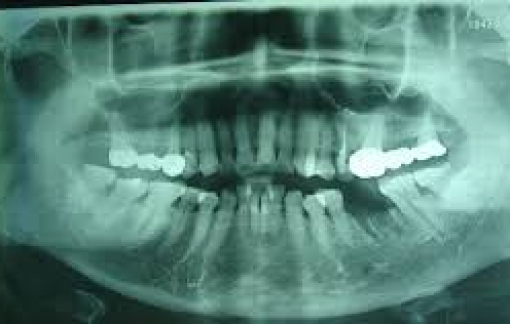 Bộ Y tế yêu cầu xác định nguyên nhân gây hoại tử xương hàm liên quan COVID-19