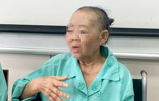 Hoại tử xương hàm, xương sọ có đúng do di chứng hậu COVID-19?