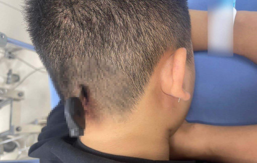 Kinh hoàng nam thanh niên bị chìa khóa cắm xuyên xương sọ