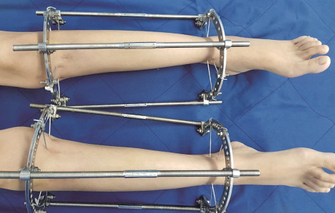 Phẫu thuật kéo dài chân có nguy hiểm?