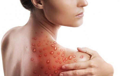 Bệnh đậu mùa khỉ có thể lây truyền qua quần áo, khăn tắm