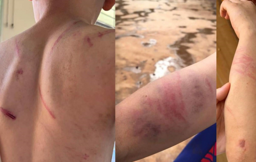 Vụ cháu bé 9 tuổi bị bạo hành đến bầm tím: Khởi tố cha ruột và bà nội