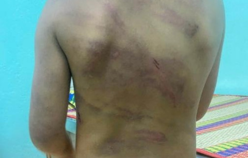 Bình Phước: Làm rõ bé gái bị bạo hành với nhiều vết thương trên người