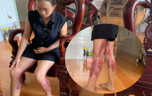 Người phụ nữ kêu cứu vì bị chồng cũ quấy rối, tạt nước sôi khiến 2 chân bỏng nặng