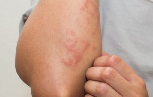 Cứ mắc mưa là da bị nổi hồng ban, mụn nước