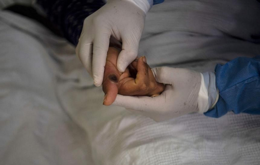 Mỹ: Virus đậu mùa khỉ có thể tồn tại trên đồ gia dụng thông thường