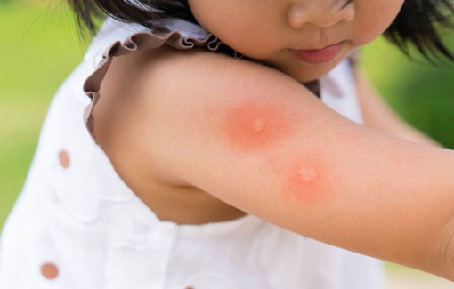 Những trẻ nào có thể nguy kịch khi mắc sốt xuất huyết?