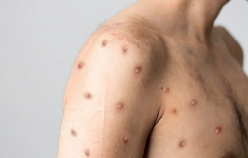 Người đàn ông nhiễm COVID-19, bệnh đậu khỉ và HIV cùng một lúc