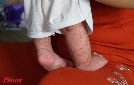 TPHCM lo ngại bệnh sởi chồng lên sốt xuất huyết và COVID-19