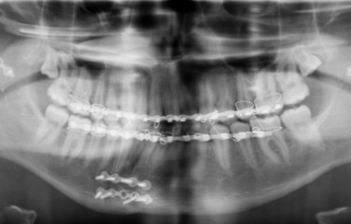 Một thiếu niên Pháp bị gãy xương hàm hiếm gặp