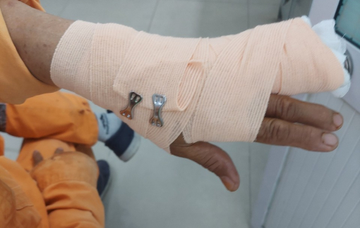 Đến nhắc nợ, nhân viên công ty Điện lực bị đánh đứt gân ngón tay