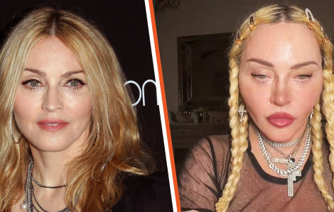 Madonna bị chỉ trích vì quá lạm dụng dao kéo