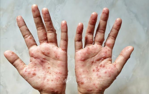 Mỹ ghi nhận thêm 6 ca tử vong do đậu mùa khỉ
