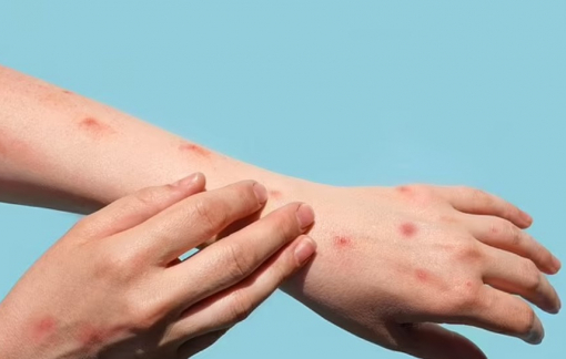 Bệnh đậu mùa khỉ có thể đã lây lan 4 ngày trước khi phát ban