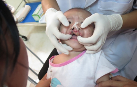 Hơn 20.000 lượt bệnh nhân bị dị tật khe hở môi – vòm miệng được điều trị toàn diện