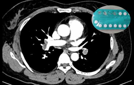 Uống thuốc tránh thai nhiều năm, người phụ nữ bị thuyên tắc phổi