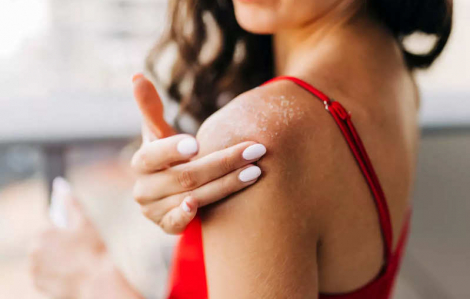 Làm gì khi da bị dị ứng kem chống nắng?