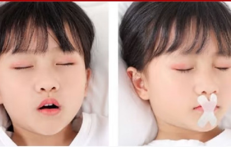 Bác sĩ cảnh báo dán miệng trẻ nhỏ để chữa răng thưa, đầu bẹt khi ngủ gây nguy hiểm