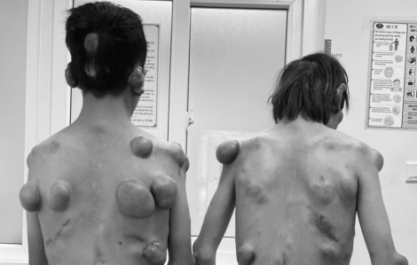 Hai anh em sinh đôi "người củi" mắc bệnh hiếm với hàng trăm khối u trên cơ thể